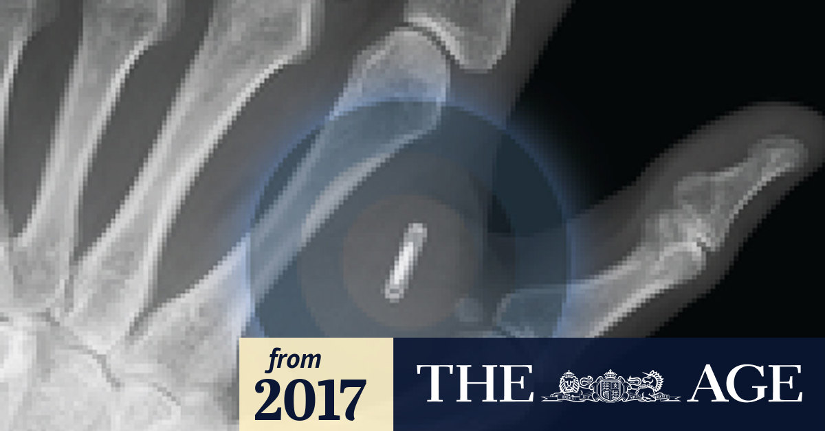 Video Human microchip implanted in workers